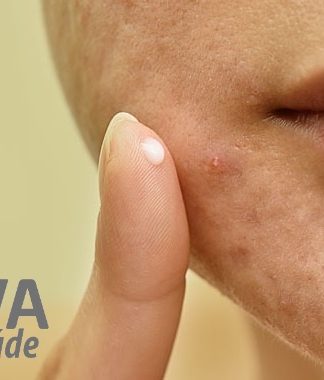 Viva com Saúde – 24/01/2023 – Acne pode surgir por fatores genéticos e estressantes