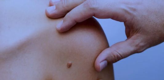 Tecnologia inovadora é aprovada para tratar câncer de pele no SUS