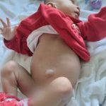 Caso raríssimo: Bebê nasce com 4 rins no Brasil