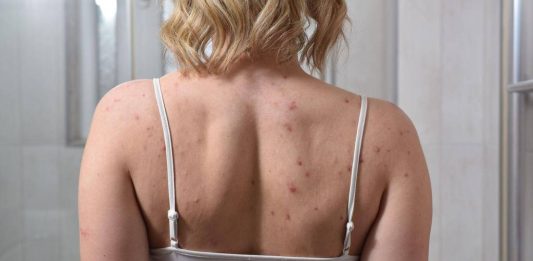 'Chip da Beleza' preocupa médicos e pode causar até AVC