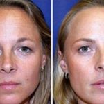 Compare fotos de gêmeas! Uma usou botox por 19 anos, outra não