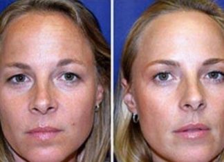 Compare fotos de gêmeas! Uma usou botox por 19 anos, outra não