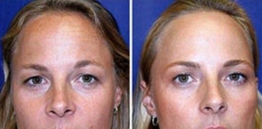 Compare fotos de gêmeas! Uma usou botox por 19 anos, outra não