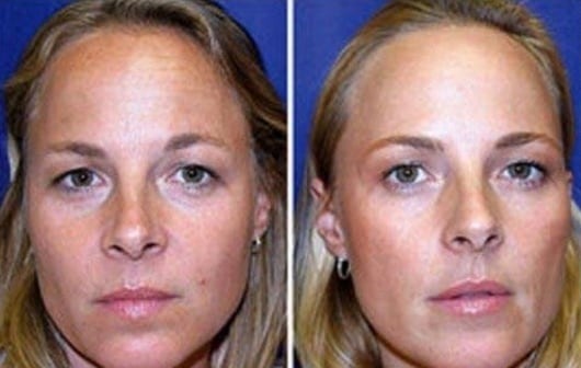 Compare fotos de gêmeas! Uma usou botox por 19 anos, outra não