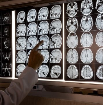 Por que a obesidade tem efeitos semelhantes ao Alzheimer?