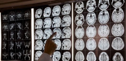 Por que a obesidade tem efeitos semelhantes ao Alzheimer?