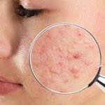 Bactérias responsáveis pela acne foram mudadas geneticamente para tratá-la