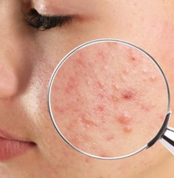 Bactérias responsáveis pela acne foram mudadas geneticamente para tratá-la
