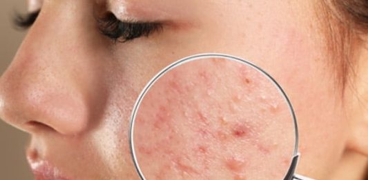 Bactérias responsáveis pela acne foram mudadas geneticamente para tratá-la