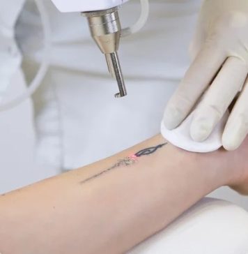 Remoção a laser de tatuagem: há risco de câncer?