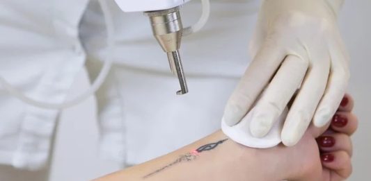 Remoção a laser de tatuagem: há risco de câncer?