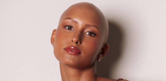 Foto: A modelo Yasmin Brito, 23, nasceu com alopecia androgenética congênita, ou seja, nunca teve cabelo/Arquivo pessoal